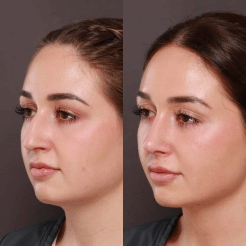 Rhinoplasty Before & After (4)
