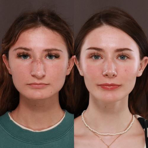 Rhinoplasty Before & After