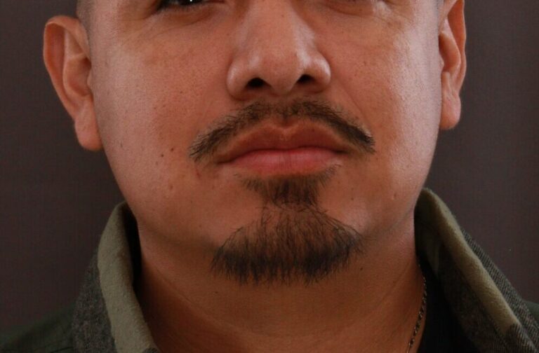 After Image: FUE Mustache and Beard Transplant - front