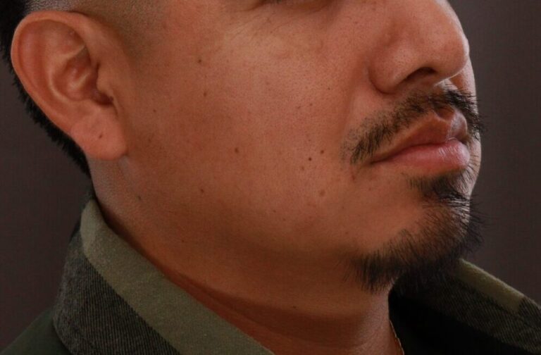 After Image: FUE Mustache and Beard Transplant - 