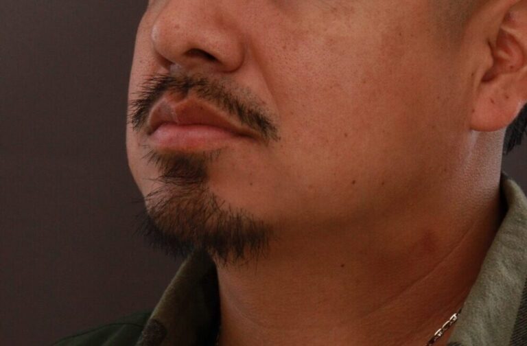 After Image: FUE Mustache and Beard Transplant - 