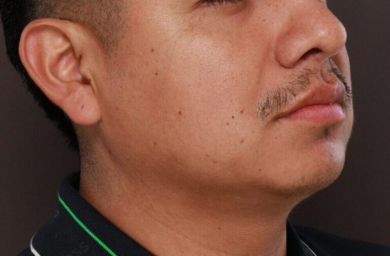 Before Image: FUE Mustache and Beard Transplant - 