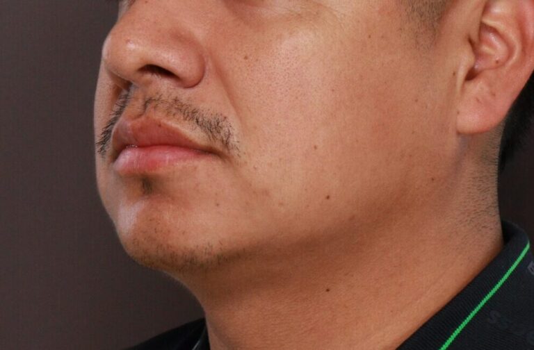 Before Image: FUE Mustache and Beard Transplant - 