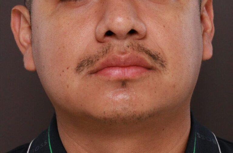 Before Image: FUE Mustache and Beard Transplant - front