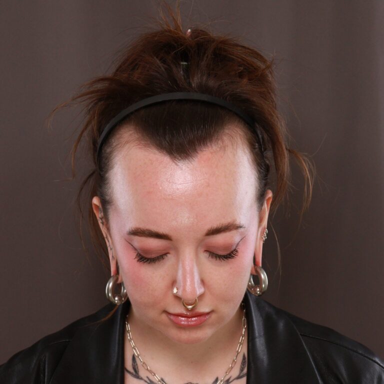 Before Image: FUT Hair Transplant, 2600 grafts - front