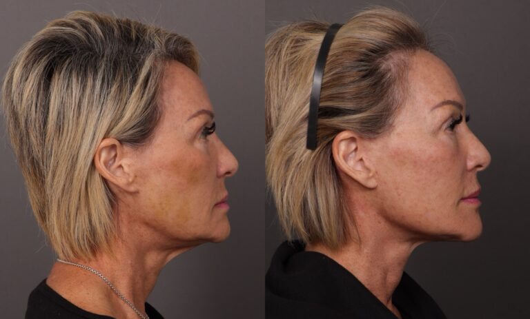 After Image: Facelift & Fat Grafting - 