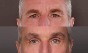 After Image: Endoscopic Brow Lift