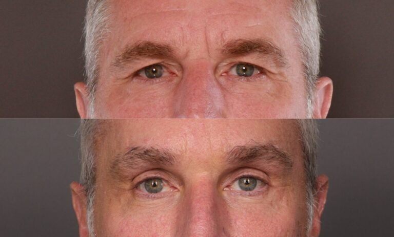 After Image: Endoscopic Brow Lift - front