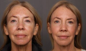 After Image: HALO Tribrid Laser