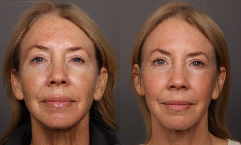 After Image: HALO Tribrid Laser - front