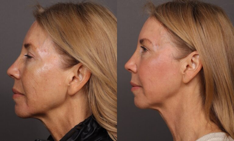 After Image: HALO Tribrid Laser - 