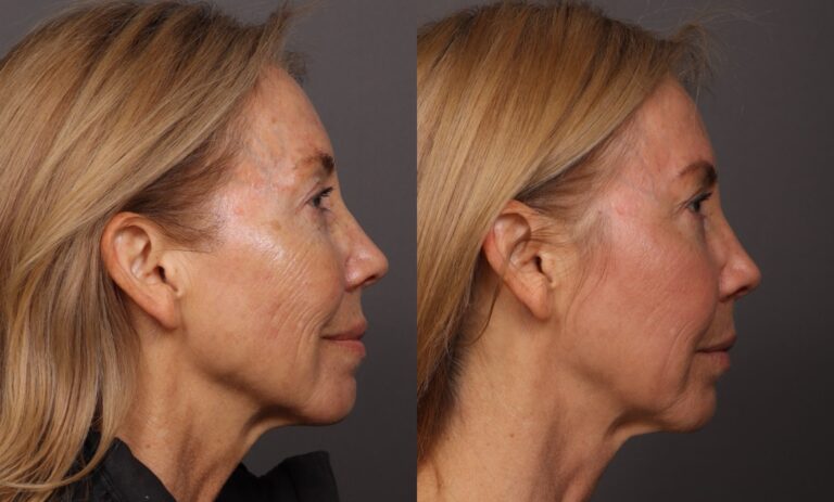 Before Image: HALO Tribrid Laser - 