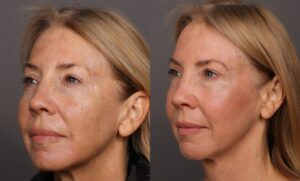 Before Image: HALO Tribrid Laser