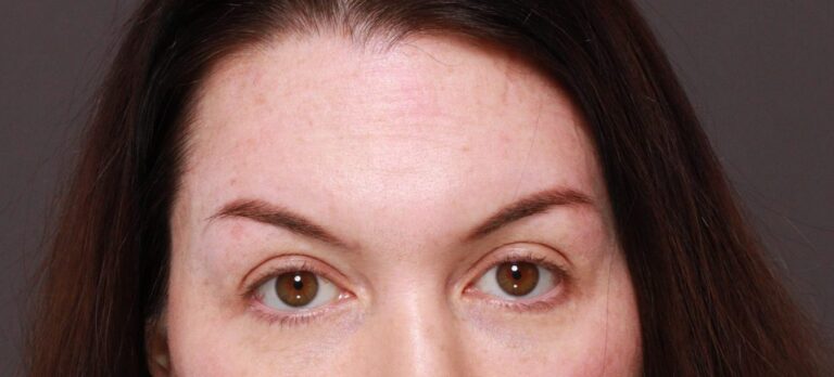 Before Image: FUT Eyebrow Transplant - 