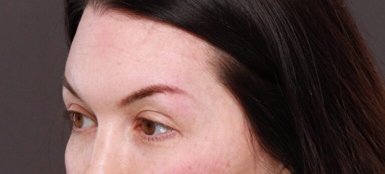 Before Image: FUT Eyebrow Transplant - 