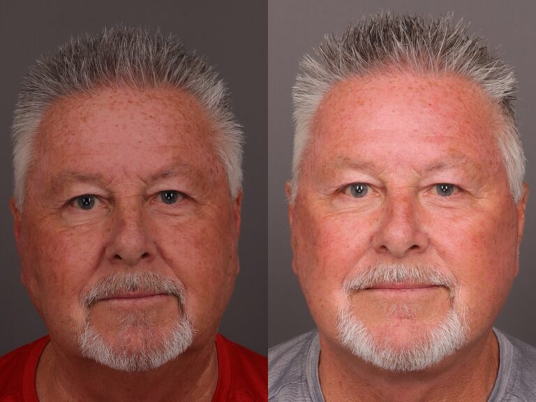 After Image: Facelift - 