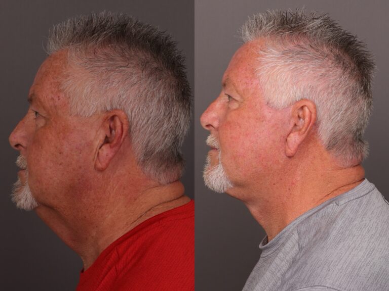 After Image: Facelift - front