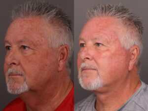 Before Image: Facelift