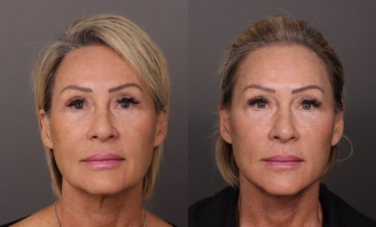 Before Image: Facelift & Fat Grafting - 