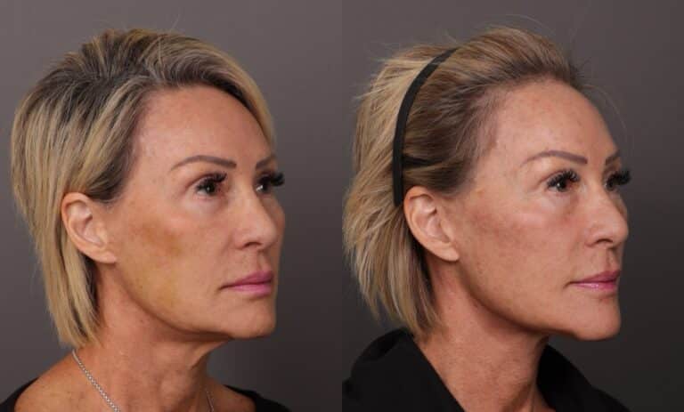 After Image: Facelift & Fat Grafting - front