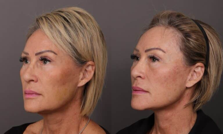 Before Image: Facelift & Fat Grafting - front