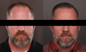 Before Image: FUE Hair Transplant