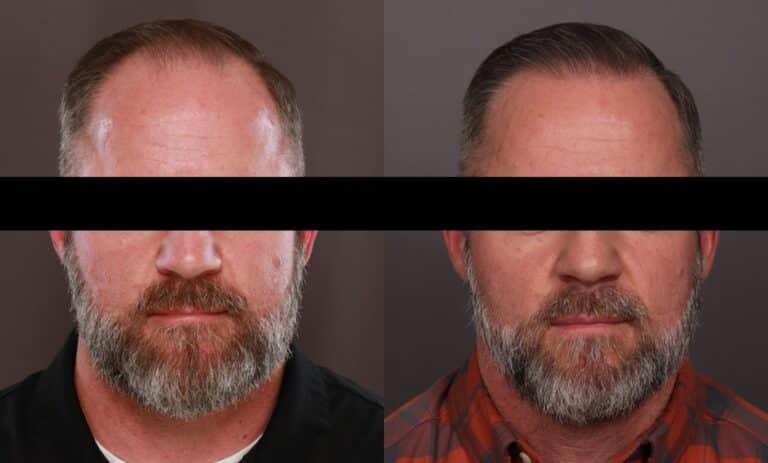 Before Image: FUE Hair Transplant - front