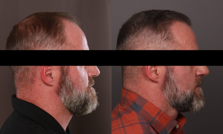 Before Image: FUE Hair Transplant - front