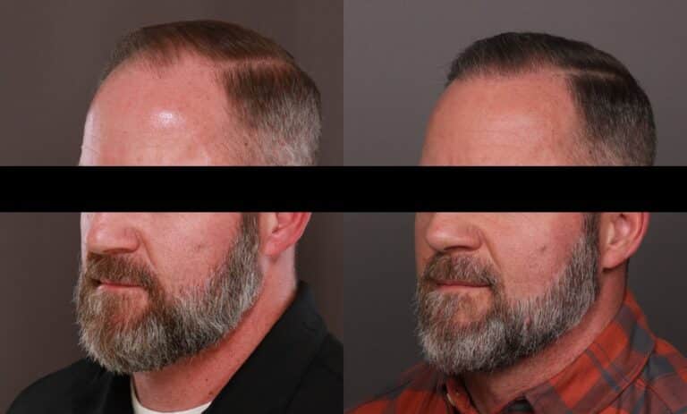 After Image: FUE Hair Transplant - front