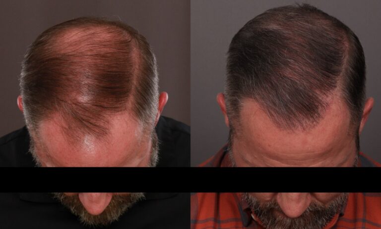 After Image: FUE Hair Transplant - front