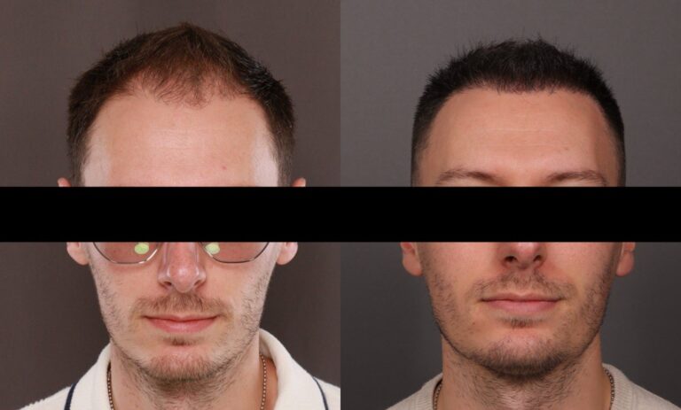 Before Image: FUE Hair Transplant - front