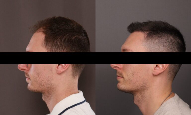 After Image: FUE Hair Transplant - front