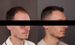 After Image: FUE Hair Transplant
