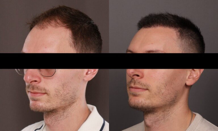 Before Image: FUE Hair Transplant - front