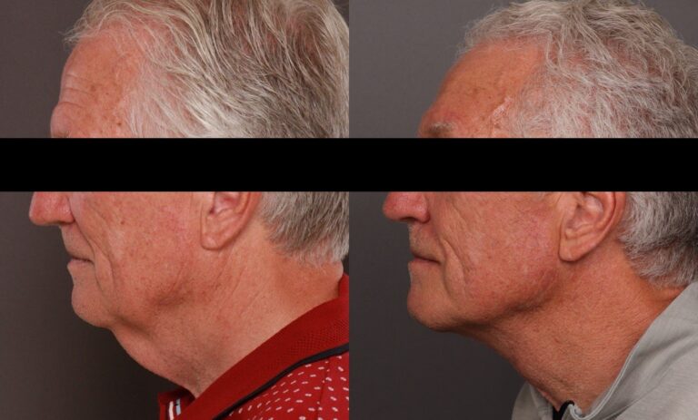 Before Image: Direct Neck Lift - 