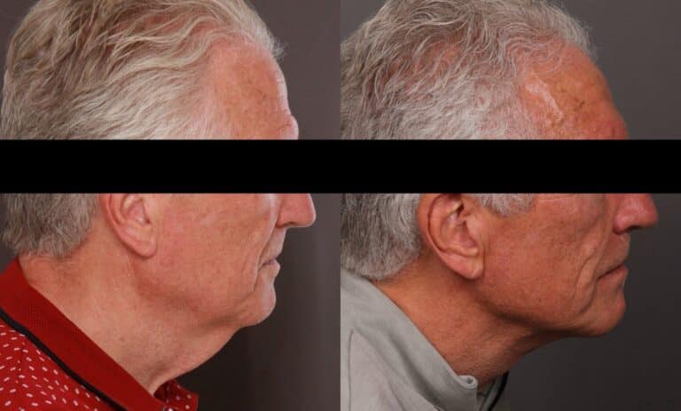Before Image: Direct Neck Lift - front