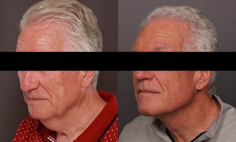 After Image: Direct Neck Lift - front