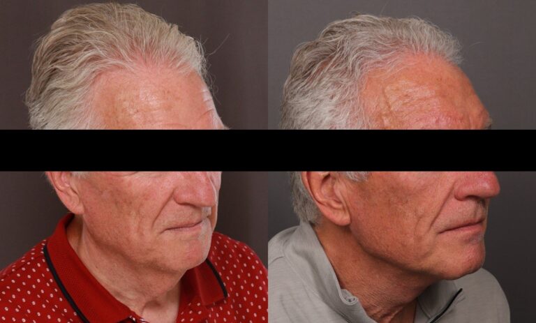 After Image: Direct Neck Lift - 