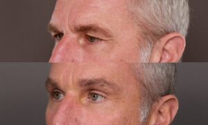Before Image: Endoscopic Brow Lift