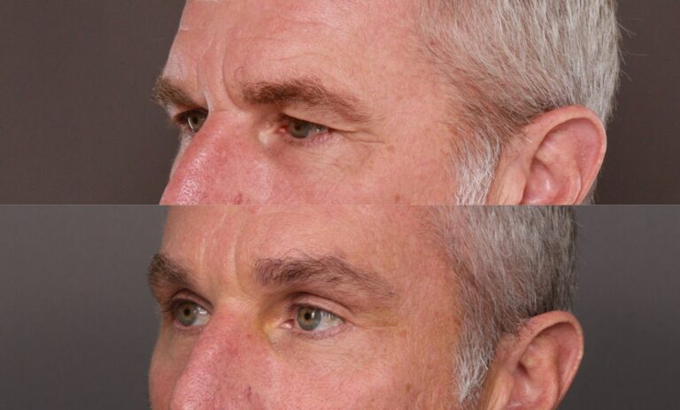 Before Image: Endoscopic Brow Lift - front