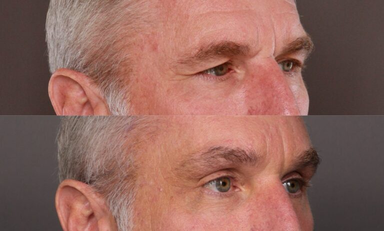 Before Image: Endoscopic Brow Lift - 