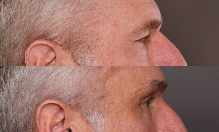 After Image: Endoscopic Brow Lift - 