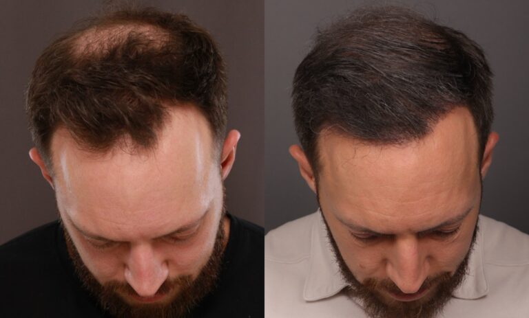 Before Image: FUE Hair Transplant - front