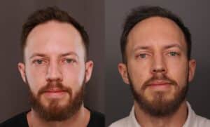 After Image: FUE Hair Transplant