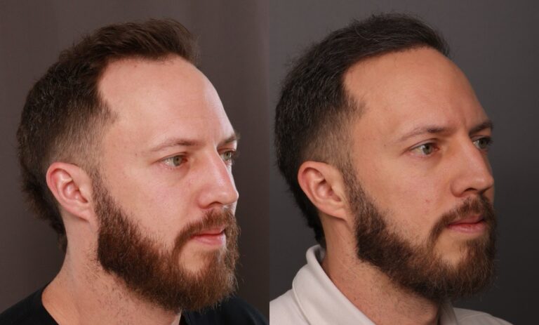 Before Image: FUE Hair Transplant - 