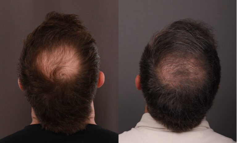 After Image: FUE Hair Transplant - 