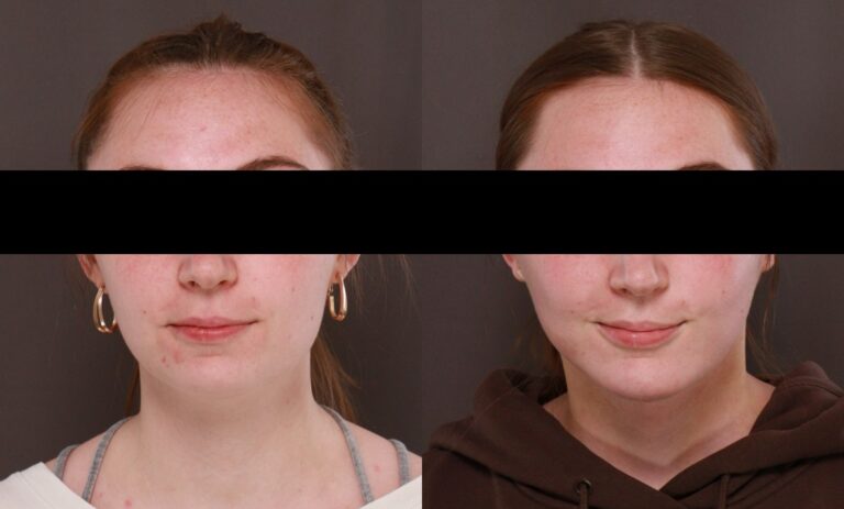 After Image: Deep Neck Contouring - 