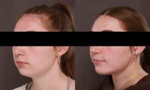 After Image: Deep Neck Contouring