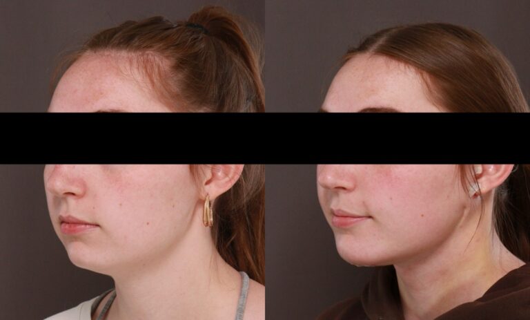 After Image: Deep Neck Contouring - front
