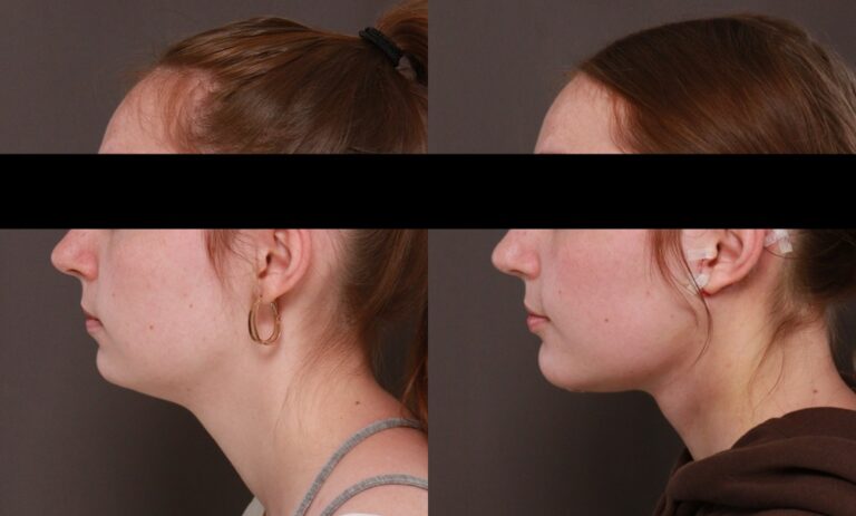 Before Image: Deep Neck Contouring - front